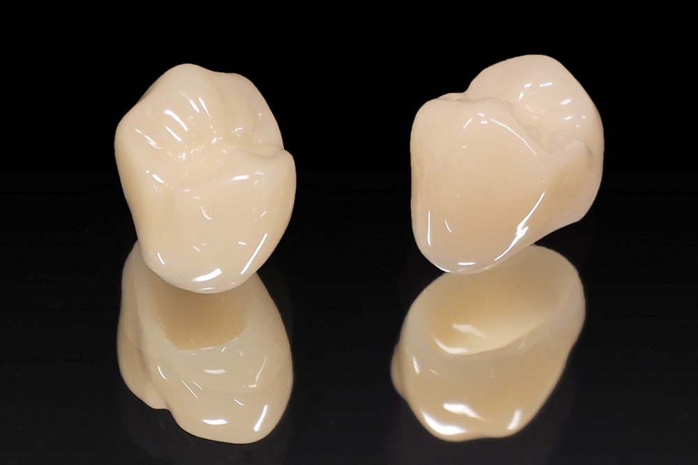 自由診療でできるつめ物、かぶせ物について